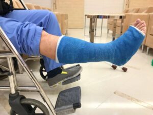 Broken leg injury from car accident.